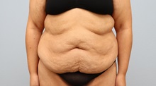 Tummy Tuck Before Photo by Keith Neaman, MD; ,  - Case 50275
