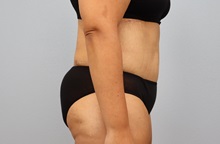 Tummy Tuck After Photo by Keith Neaman, MD; Salem, OR - Case 50275