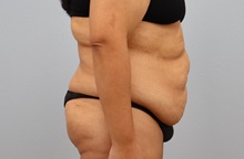 Tummy Tuck Before Photo by Keith Neaman, MD; Salem, OR - Case 50275