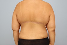 Tummy Tuck After Photo by Keith Neaman, MD; Salem, OR - Case 50275
