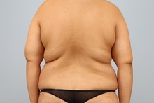 Tummy Tuck Before Photo by Keith Neaman, MD; Salem, OR - Case 50275