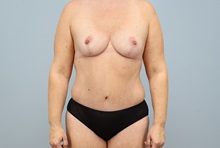 Mommy Makeover After Photo by Keith Neaman, MD; Salem, OR - Case 50277