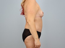 Mommy Makeover After Photo by Keith Neaman, MD; Salem, OR - Case 50277