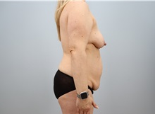 Mommy Makeover Before Photo by Keith Neaman, MD; Salem, OR - Case 50277