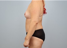 Mommy Makeover After Photo by Keith Neaman, MD; Salem, OR - Case 50277