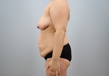 Mommy Makeover Before Photo by Keith Neaman, MD; Salem, OR - Case 50277