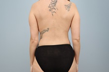 Mommy Makeover After Photo by Keith Neaman, MD; Salem, OR - Case 50279