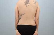 Mommy Makeover Before Photo by Keith Neaman, MD; Salem, OR - Case 50279