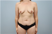 Mommy Makeover Before Photo by Keith Neaman, MD; Salem, OR - Case 50314