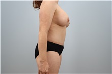 Mommy Makeover After Photo by Keith Neaman, MD; Salem, OR - Case 50314