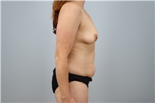 Mommy Makeover Before Photo by Keith Neaman, MD; Salem, OR - Case 50314