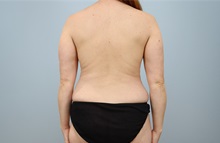 Mommy Makeover Before Photo by Keith Neaman, MD; Salem, OR - Case 50314