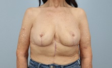 Breast Reduction After Photo by Keith Neaman, MD; Salem, OR - Case 50315