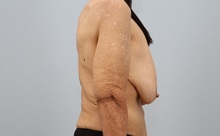 Breast Reduction Before Photo by Keith Neaman, MD; Salem, OR - Case 50315