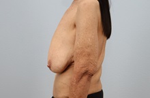 Breast Reduction Before Photo by Keith Neaman, MD; Salem, OR - Case 50315