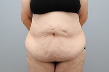 Tummy Tuck Before Photo by Keith Neaman, MD; Salem, OR - Case 50422