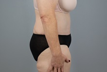 Tummy Tuck After Photo by Keith Neaman, MD; Salem, OR - Case 50422