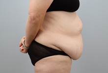 Tummy Tuck Before Photo by Keith Neaman, MD; Salem, OR - Case 50422