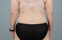 Tummy Tuck After Photo by Keith Neaman, MD; Salem, OR - Case 50422