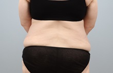 Tummy Tuck Before Photo by Keith Neaman, MD; Salem, OR - Case 50422
