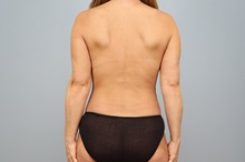 Mommy Makeover After Photo by Keith Neaman, MD; Salem, OR - Case 50423