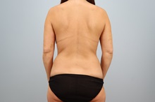 Mommy Makeover Before Photo by Keith Neaman, MD; Salem, OR - Case 50423