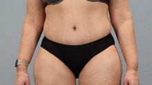 Tummy Tuck After Photo by Keith Neaman, MD; Salem, OR - Case 50446