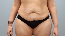 Tummy Tuck Before Photo by Keith Neaman, MD; Salem, OR - Case 50446