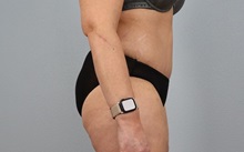 Tummy Tuck After Photo by Keith Neaman, MD; Salem, OR - Case 50446