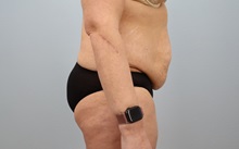 Tummy Tuck Before Photo by Keith Neaman, MD; Salem, OR - Case 50446