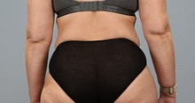 Tummy Tuck After Photo by Keith Neaman, MD; Salem, OR - Case 50446