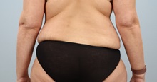 Tummy Tuck Before Photo by Keith Neaman, MD; Salem, OR - Case 50446
