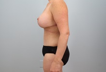 Mommy Makeover After Photo by Keith Neaman, MD; Salem, OR - Case 50499