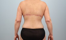 Mommy Makeover After Photo by Keith Neaman, MD; Salem, OR - Case 50499