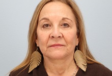 Facelift After Photo by Keith Neaman, MD; Salem, OR - Case 50505