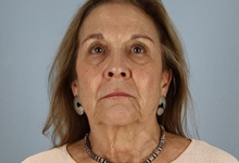 Facelift Before Photo by Keith Neaman, MD; Salem, OR - Case 50505