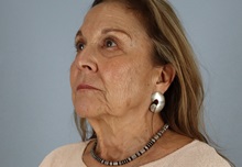 Facelift Before Photo by Keith Neaman, MD; Salem, OR - Case 50505