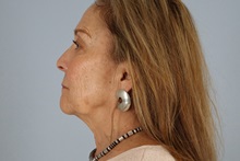 Facelift Before Photo by Keith Neaman, MD; Salem, OR - Case 50505