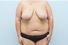 Mommy Makeover Before Photo by Keith Neaman, MD; Salem, OR - Case 50546