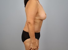 Mommy Makeover After Photo by Keith Neaman, MD; Salem, OR - Case 50546