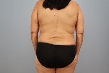 Mommy Makeover After Photo by Keith Neaman, MD; Salem, OR - Case 50546