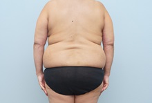 Mommy Makeover Before Photo by Keith Neaman, MD; Salem, OR - Case 50546