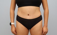Tummy Tuck After Photo by Keith Neaman, MD; Salem, OR - Case 50766