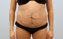 Tummy Tuck Before Photo by Keith Neaman, MD; Salem, OR - Case 50766