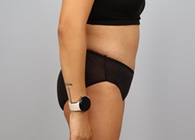 Tummy Tuck After Photo by Keith Neaman, MD; Salem, OR - Case 50766