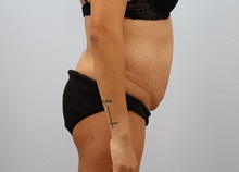 Tummy Tuck Before Photo by Keith Neaman, MD; Salem, OR - Case 50766