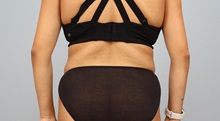 Tummy Tuck After Photo by Keith Neaman, MD; Salem, OR - Case 50766