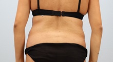 Tummy Tuck Before Photo by Keith Neaman, MD; Salem, OR - Case 50766