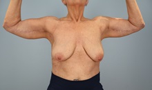 Arm Lift After Photo by Keith Neaman, MD; Salem, OR - Case 50768