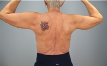 Arm Lift After Photo by Keith Neaman, MD; Salem, OR - Case 50768